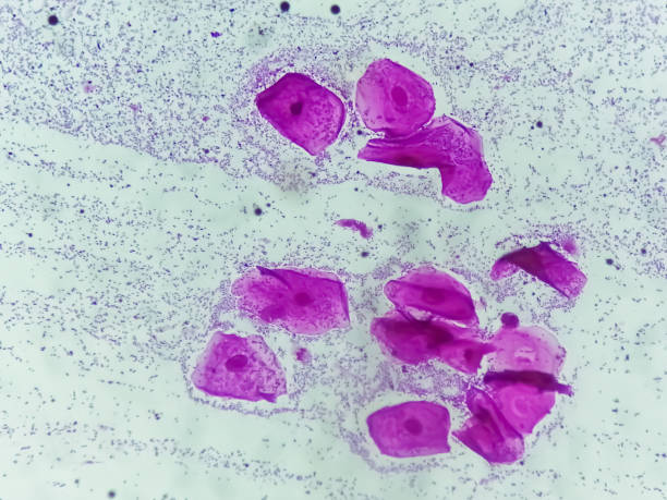 Bacterial Vaginosis